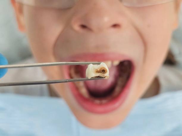 Best Emergency Tooth Extraction in Seal Beach, CA